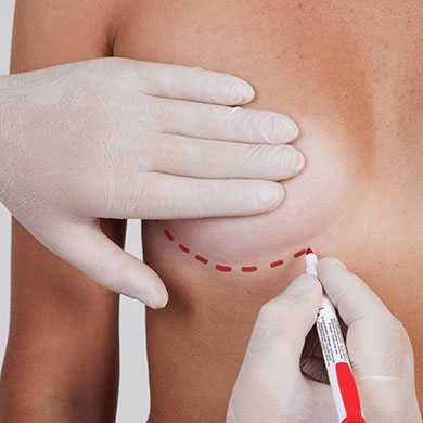 Breast Surgery